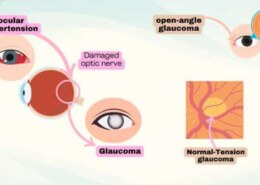 How Long Does Lumigan 0.01% Take to Provide Relief from Ocular Pressure?