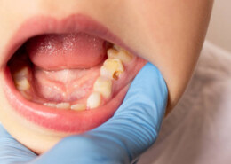 Why Untreated Cavities in Baby Teeth Cause Harm in Permanent Teeth?