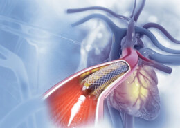 Does Mediclaim Cover Heart Surgery Within the First 6 Months in India?