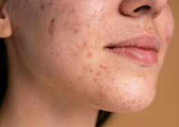 Which Acne Treatment Is Right for Your Skin Type?