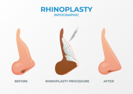 Rhinoplasty 101: Everything You Need to Know Before Your Nose Job