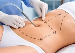 Vibro Liposuction for Lasting Body Confidence | Glamorous Clinic in Dubai