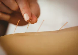 Acupuncture Clinic For Pain NYC