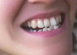 Braces for Crooked Teeth in Dubai | Glamorous Clinic Dubai