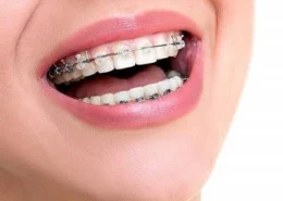 Teeth Braces in Dubai & Abu Dhabi for Smile Correction | Glamorous Clinic Dubai