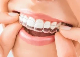 Invisalign Treatment Dubai & Abu Dhabi for a More Balanced Smile | Glamorous Clinic Dubai
