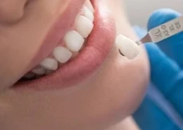 Ceramic Crown Dubai & Abu Dhabi for Modern Dental Restoration | Glamorous Clinic Dubai