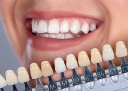 Achieve a Symmetrical Smile with Dental Veneers in Dubai & Abu Dhabi | Glamorous Clinic Dubai