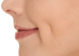 Dimpleplasty in Dubai & Abu Dhabi | Glamorous Clinic Dubai