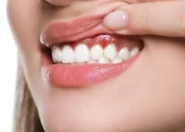 Personalized Gum Contouring Dubai & Abu Dhabi | Glamorous Clinic Dubai