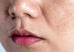 Dark Spots Removal Treatment in Dubai & Abu Dhabi | Glamorous Clinic Dubai